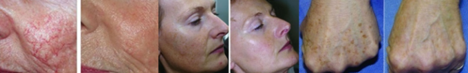 IPL Beauty Machine Usuwanie pigmentu Odmładzanie skóry Salon piękności Górna warga